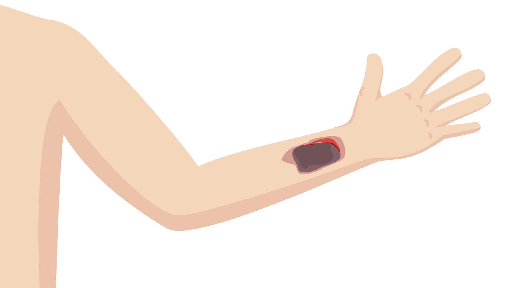 Skin Ripping Apart Treating a person with a: Skin tear