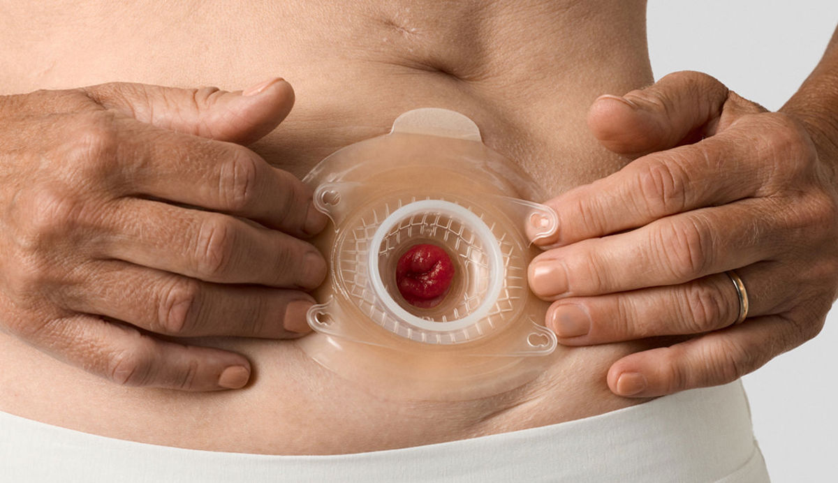 Depth and slope - A mirror image of the peristomal plane