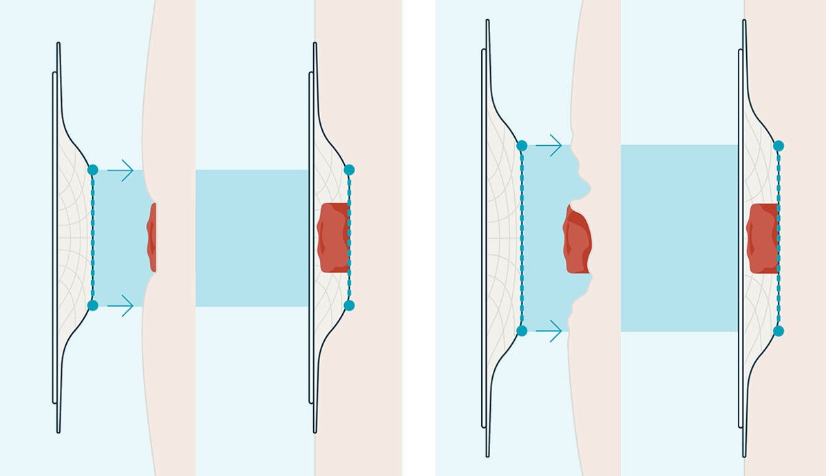 Tension Location positioning is key<sup>3</sup>