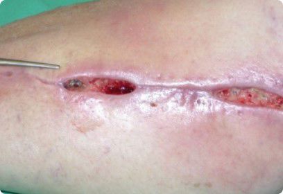 Photo showing surgical wound dehiscence