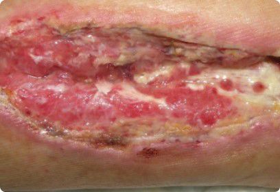 Photo showing surgical wound dehiscence