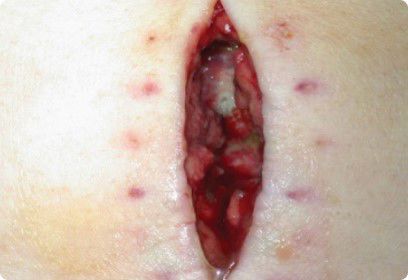 Photo showing surgical wound dehiscence