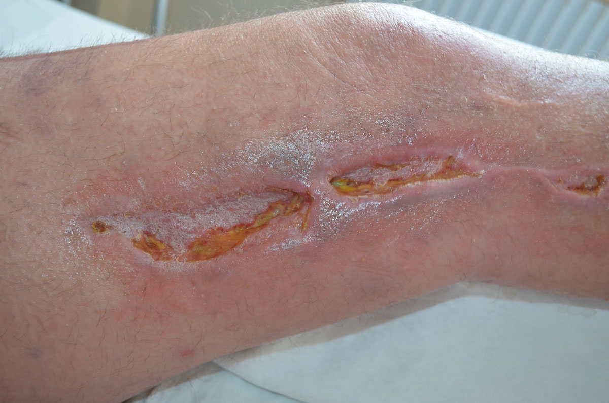 silver wound dressing side effects Quick Facts - Silver Safety